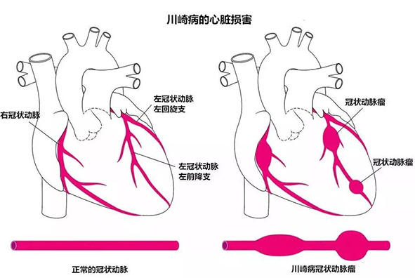 [小儿心血管疾病科普（一）]川崎病-儿童期特殊而又凶险的“冠心病