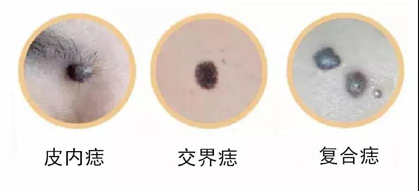 儿童全麻下皮肤肿物精细切除｜成都市妇女儿童中心医院皮肤科团队入驻本院
